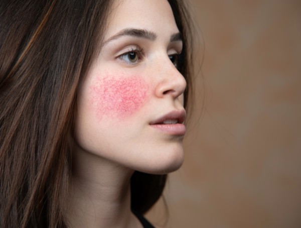 Rosacea