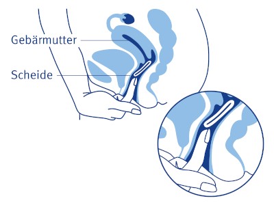 Symbolbild Vaginalring