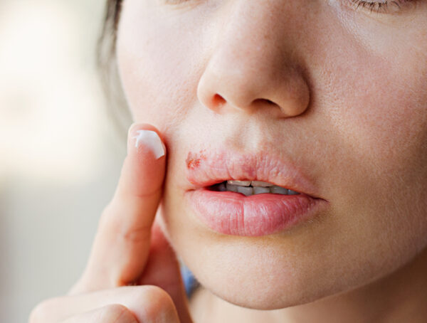 Symbolbild Herpes Fakten