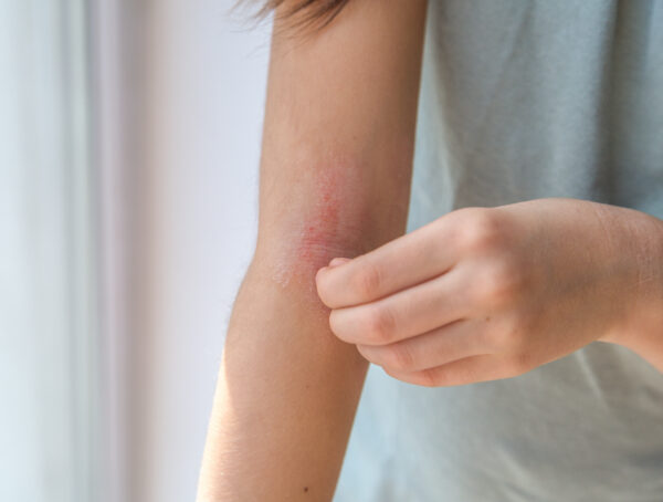 Frau kratzt sich eine rote Stelle am Arm