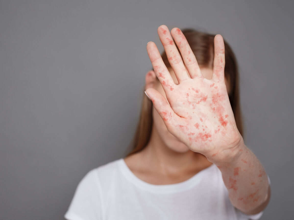 Isoniazid: Schwere Hautreaktionen unter Tuberkulose-Antibiotikum