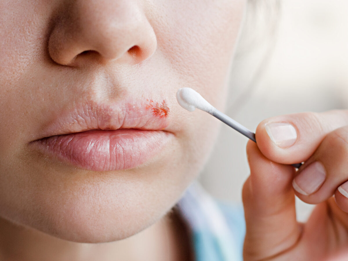 Herpes ade: Pritelivir als neue Behandlungsoption?
